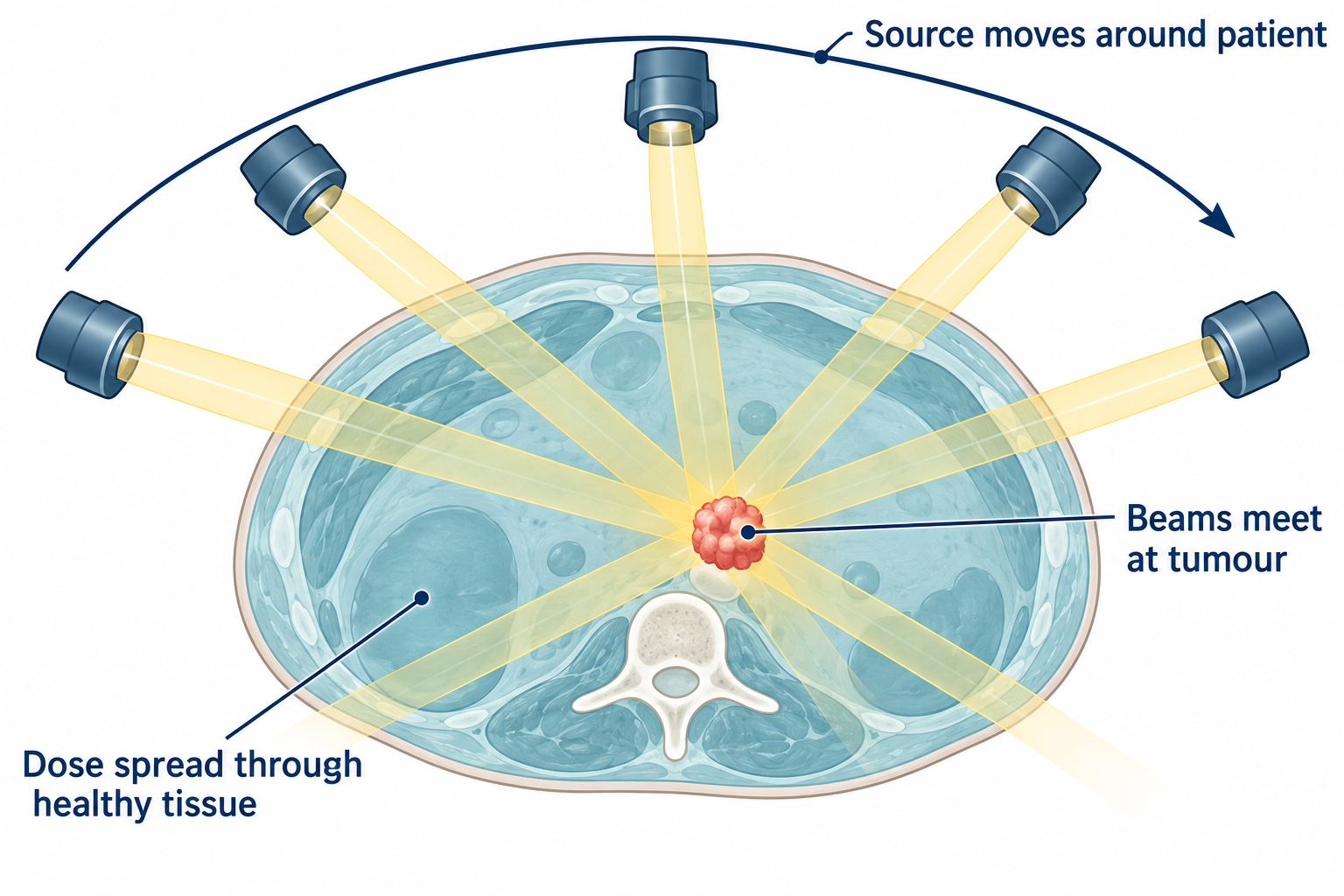 Cross-section of a torso: an external source moves around the patient. Beams from different directions meet at the tumour, concentrating the dose there and spreading it through healthy tissue.